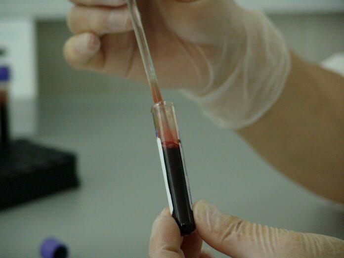 Test coronavirus analisi sangue sierologico anticorpi tampone